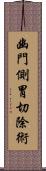 幽門側胃切除術 Scroll