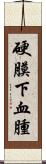 硬膜下血腫 Scroll